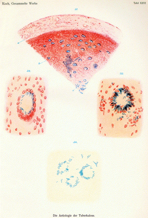 Sketch of tuberculosis bacteria and tubercules by Robert Koch